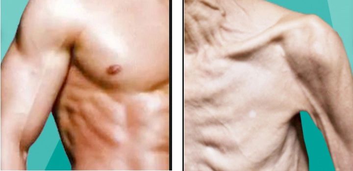 What is Sarcopenia?